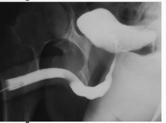 <p><strong>Retrograde Urethrogram (RUG)</strong></p><p>-Shows the integrity of the ________. Retrograde injection of radiopaque contrast into the urethra, shows _________ and injury </p>