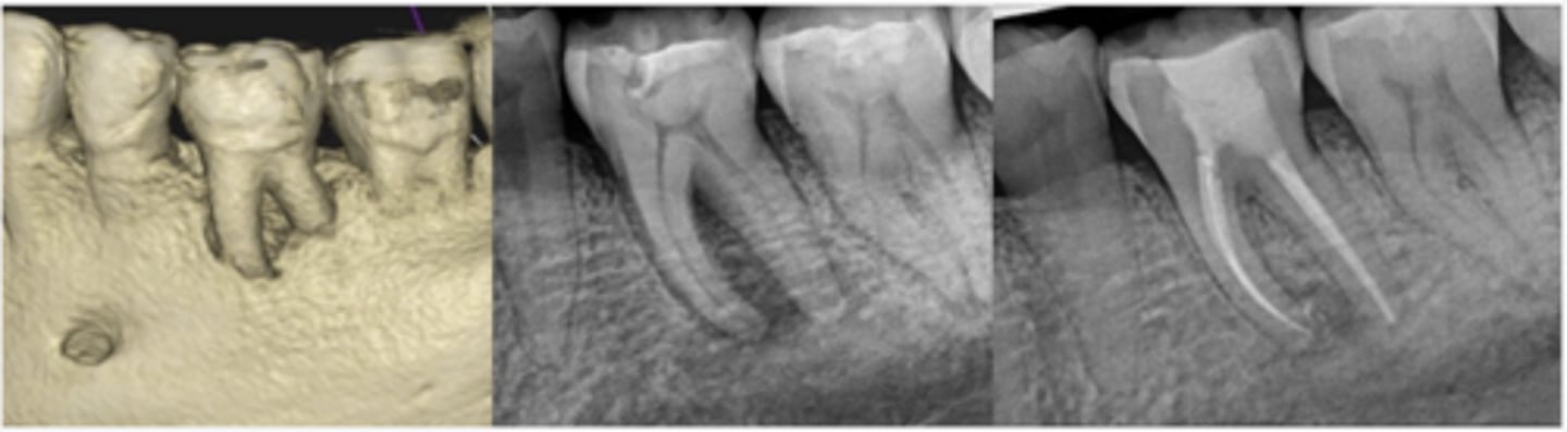 <p>What type of lesion?</p><ul><li><p>Furcation involvement and loss of buccal plate extending apically on tooth #19, visible in CBCT rendering (left) and pre-op PA radiograph (center)</p></li><li><p>Endodontic treatment was initiated and calcium hydroxide medication was placed</p></li><li><p>Four months later, tooth was obturated and healing of furcal bone was evident radiographically (right)</p></li></ul><p></p>
