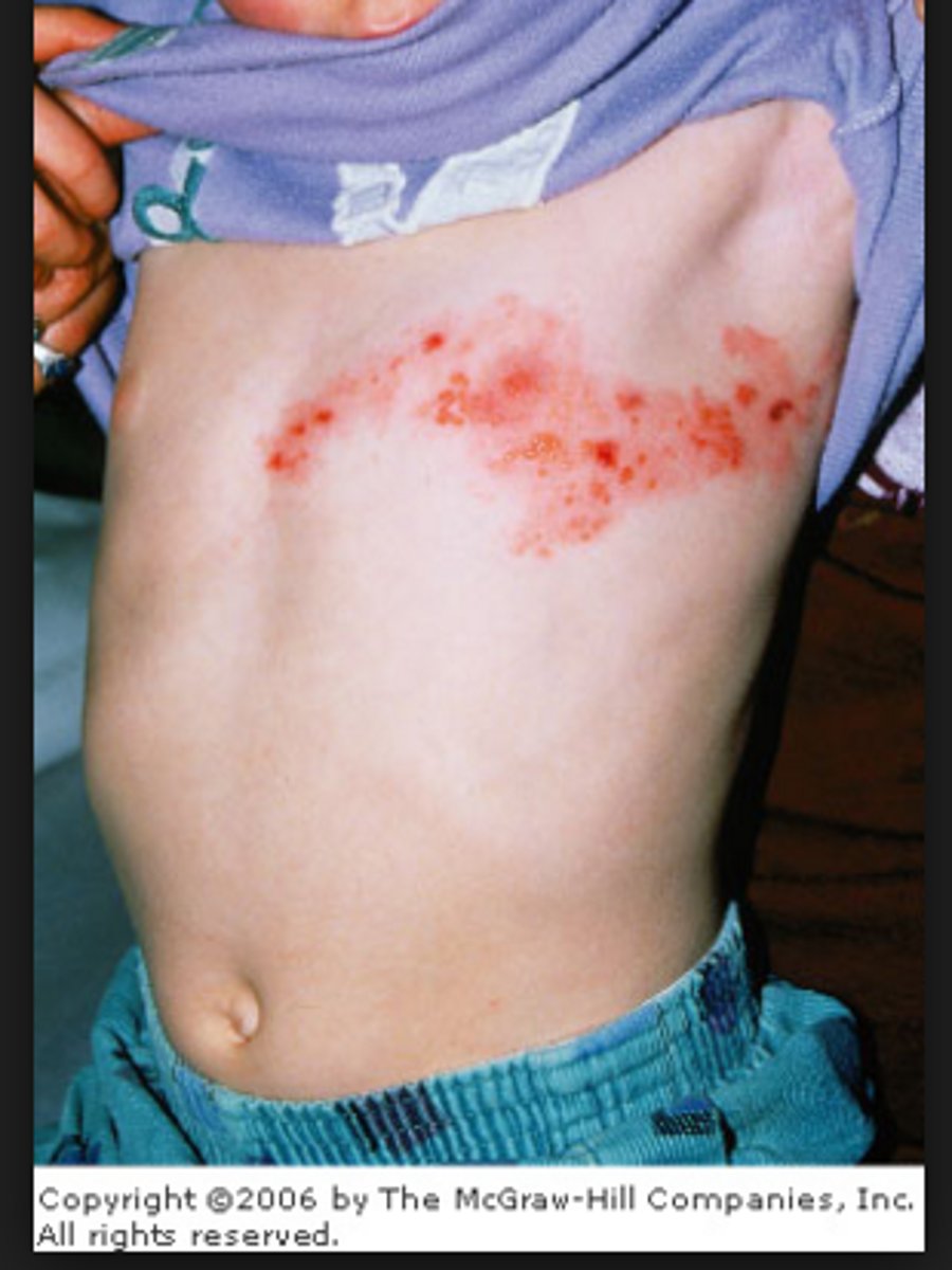 <p>is distributed along a dermatome</p><p>(think of herpes zoster)</p>