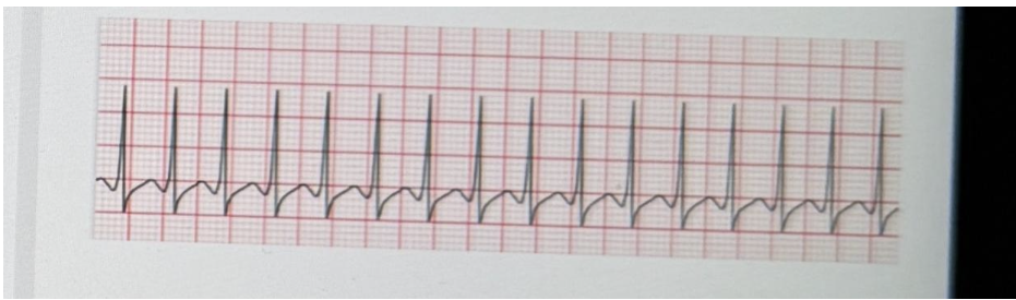 <p><span style="background-color: transparent; font-family: "Times New Roman", serif;"><span>Your patient has presented to the ED c/o chest tightness, anxiety, and heart pounding. She is diaphoretic and distressed. The EKG shows this rhythm. You identify the rhythm to be…</span></span></p><p><span style="background-color: transparent; font-family: "Times New Roman", serif;"><span>A.Ventricular fibrillation</span></span></p><p><span style="font-family: "Times New Roman", serif;"><span>B. Supraventricular T achycardia</span></span></p><p><span style="background-color: transparent; font-family: "Times New Roman", serif;"><span>C. Ventricular tachycardia</span></span></p><p><span style="background-color: transparent; font-family: "Times New Roman", serif;"><span>D. Atrial flutter</span></span></p>