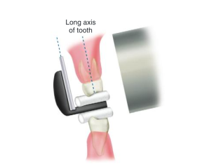 <p>Use cotton roll under the bite block (you can use on both sides if required) </p>