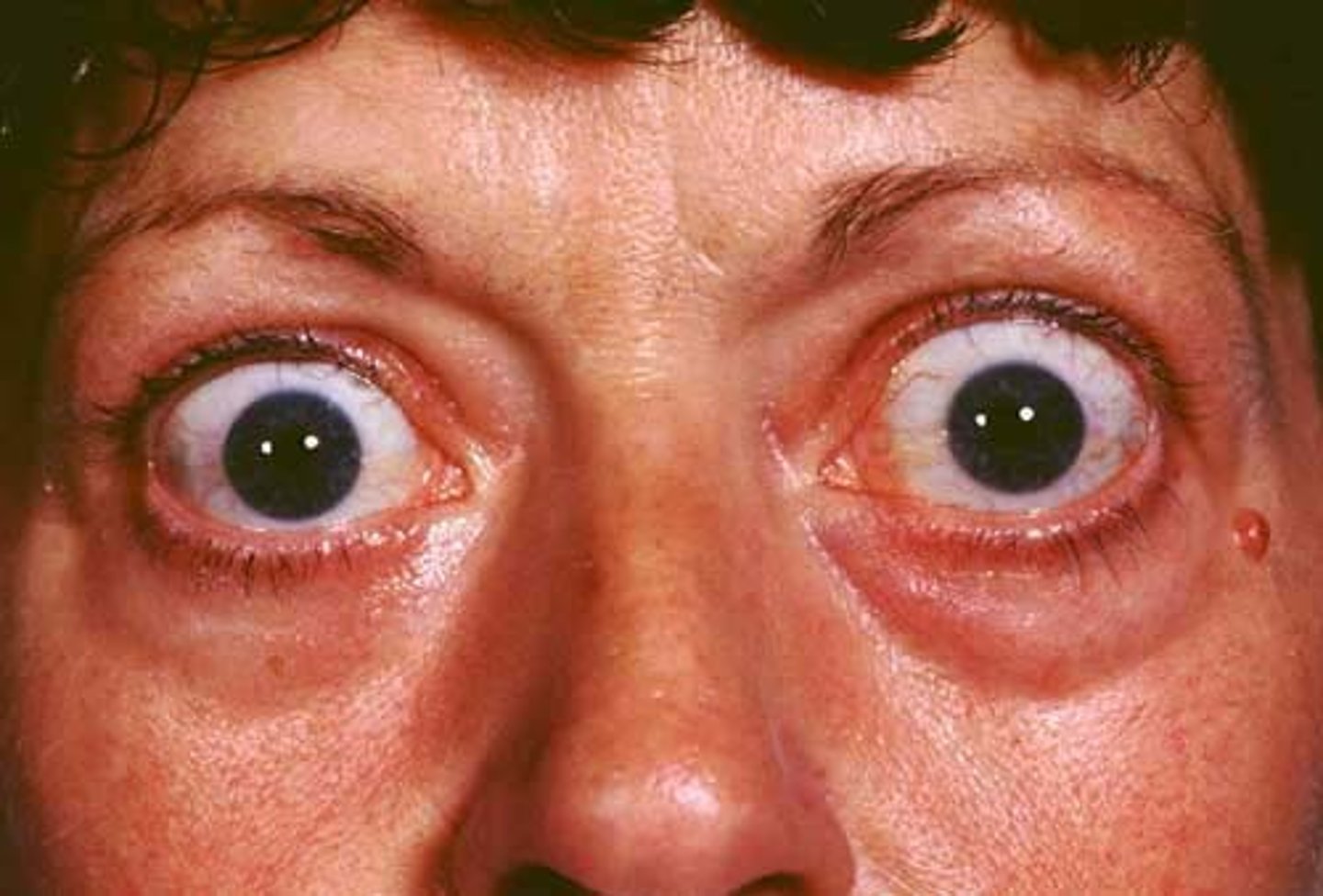 <p>- caused by edema and accumulation of fatty tissue causing abnormal protrusion of the eyeballs</p><p>&gt; common with Graves Disease</p><p>- those with it can not see it</p><p>- pts may complain of blurred vision, diplopia (double vision), eye pain, photophobia (sensitivity to light), dry eyes, lid lag</p>