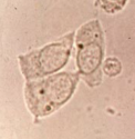 <p>Epithelial cell from inside kidney (renal tubules)</p><ul><li><p>Usually smallest epithelial cell, but bigger than WBC</p><ul><li><p>size and shape variation: cuboidal, columnar or round (usually not round and has flattened side)</p></li><li><p><u>eccentric nuclei</u></p></li></ul></li><li><p>Reabsorbs material from glomerular filtrate, can cause them to die and slough off</p></li><li><p>0-2/hpf = normal</p></li><li><p><strong><u>&gt;2/hpf = damage or necrosis to renal tubules</u></strong></p><ul><li><p>Infection, drug toxicity, heavy metals, allergic reactions</p></li></ul></li></ul><p></p>