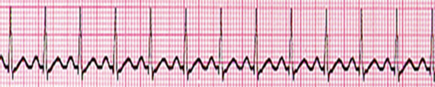 <p>Sinus tachycardia</p>