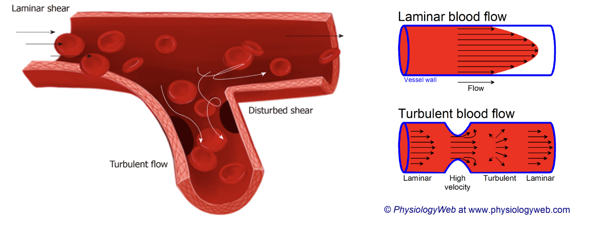 <p>Turbulent blodflöde leder till ökad risk för <strong>endoteldysfunktion</strong> genom minskad shear stress.</p><p>Normalt kommer blodet flöda med dess största komponenter (vita och röda blodkroppar) centralt i lumen medan plasma och trombocyter pressas mot kärlväggen. När detta störs kan kontakten mellan kärlvägg och olika celler att rubbas.</p><p>Turbulens påverkar även <strong>adekvat bortforsling</strong> av tex aktiverade koagulationsfaktorer. Det finns alltid en mängd cirkulerande FVII som kan aktiveras ifall sjukt endotel uttrycker tex TF. </p>