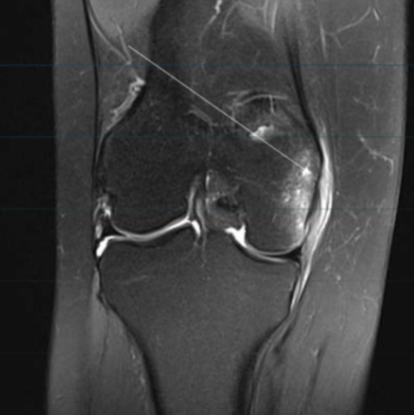 <p>Describe the pathology indicated by the arrow (Cor PD FS). </p>