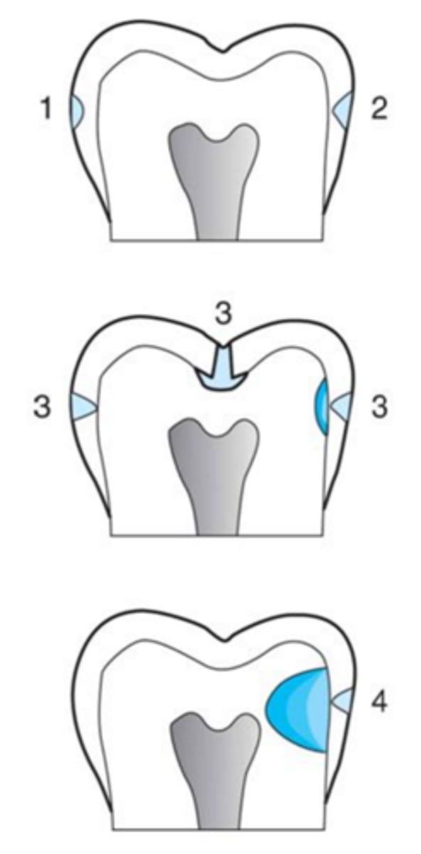 <p>surface weakening</p>