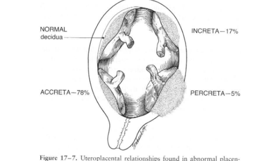 <p>Placenta adheres to/penetrates the uterus abnormally:</p><p></p><p><strong>accreta </strong>(adhesion to myometrium)&nbsp;<u> A for ADHERE</u></p><p><strong>increta </strong>(into myometrium), <strong>I for INTO</strong></p><p><strong>percreta </strong>(attaches through uterus)</p>