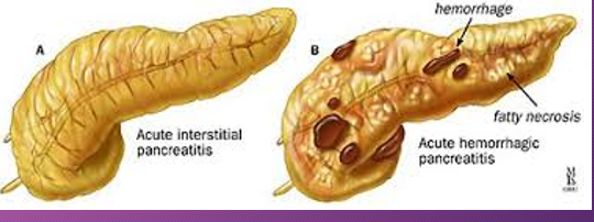<p>Sonographically, at ____ week, the mass (hemorrhage) may appear ____ with ____ elements or _______</p>