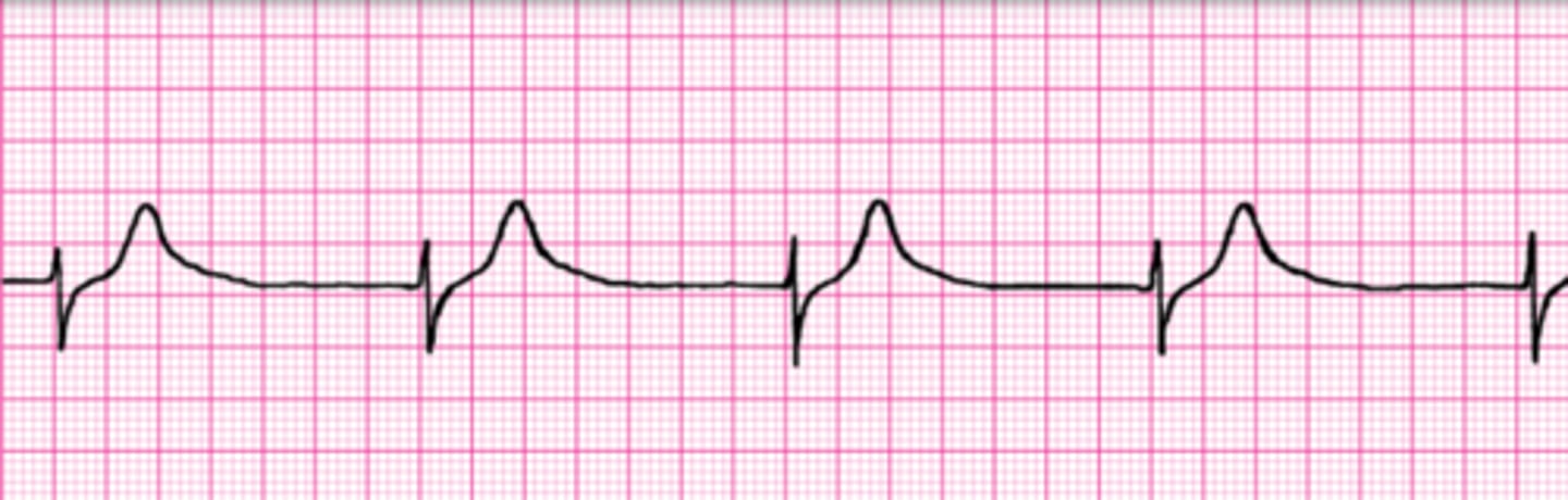 <p>HR = 38</p><p>No apparent P-waves</p>