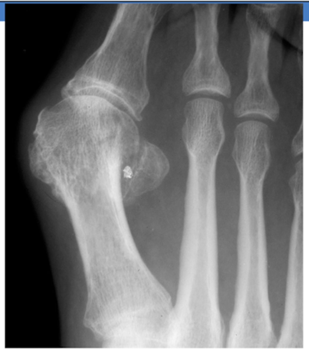 <p>hallux valgus (bunion)</p>
