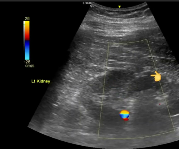 <p>Junctional parenchymal defect:</p>