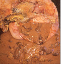 <p>Give a morphological diagnosis</p>