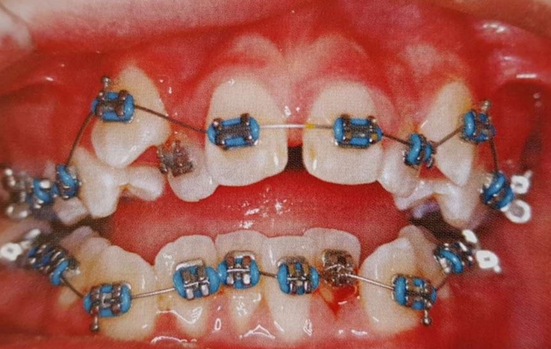 <p>Align and level crowns:</p><p class="has-focus"><strong>Crowns movement only</strong></p><p class="has-focus"><strong>Round archwire</strong></p>