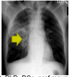 opacity of lung parenchyma, and enlargement of bronchomediastinal lymph nodes