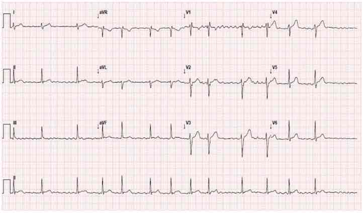 <p>Que sospechas en el siguiente EKG</p>