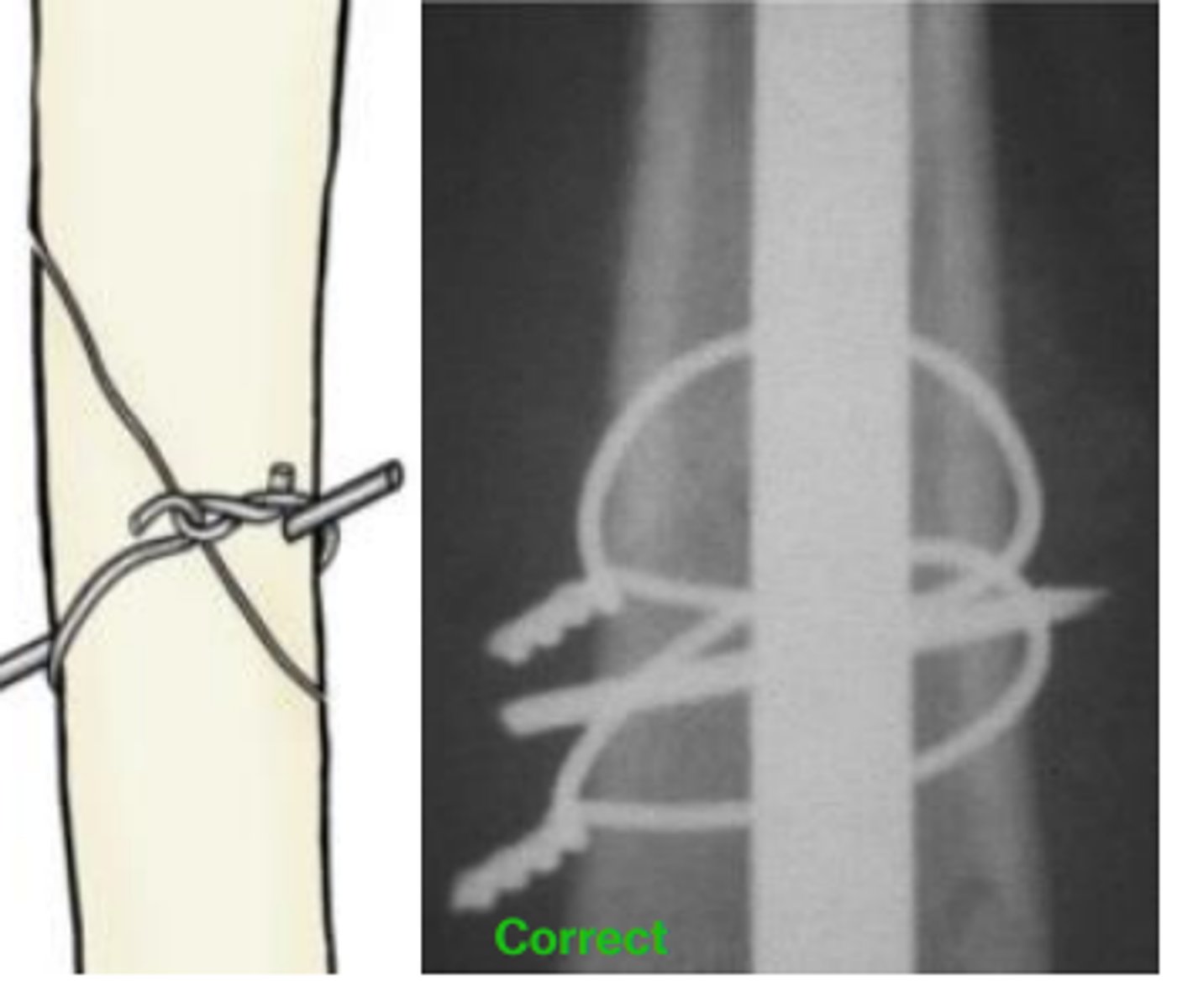 <p>- Hemi-cerclage wires + skewer pin</p><p>- Place Kirschner wire perpendicular to the fracture line. Then, apply the cerclage wire proximal to the K-wire proximally and distal to the K-wire distally</p>