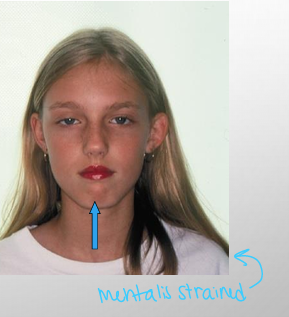 <p>-ability of the patient to have the lips contacting in the rest position without showing mentalis muscle strain</p><p>-lip incompetence: inability of the patient to have the lips contacting in the rest position without showing muscle strain or can’t fully close lips over teeth (have muscle strain when fully closed)</p>