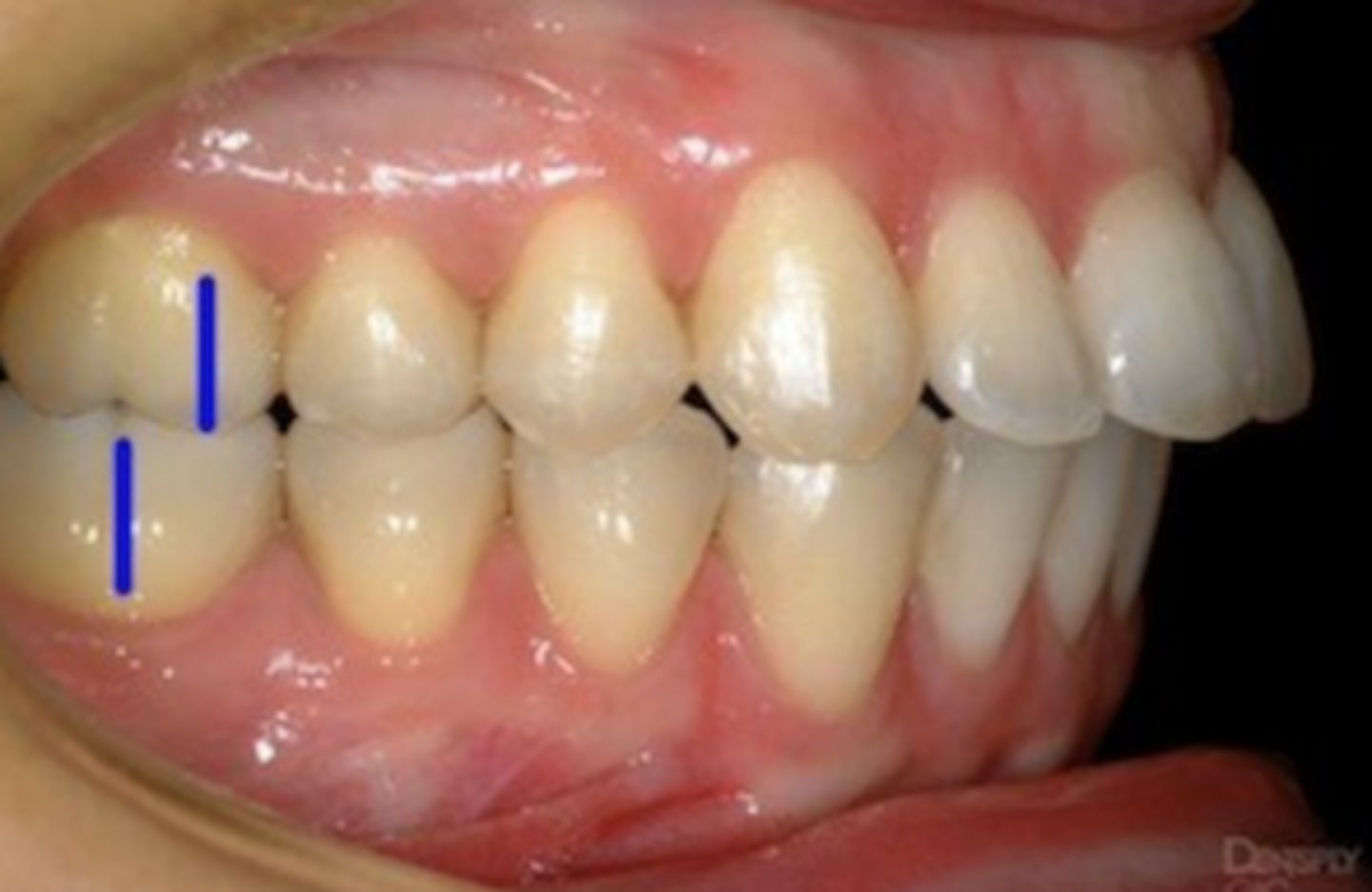 <p>Molar relationship/malocclusion?</p>