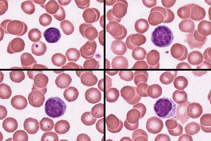 <p>-25-33%</p><p>-variable amounts of bluish cytoplasm (scanty to abundant); ovoid/round, uniform dark violet nucleus</p><p>-increased number in diverse infections and immune responses</p><p>-destroy human cells (cancer, foreign, and virally infected cells)</p><p>-secrete antibodies and provide immune memory</p><p>-provide long-term immunity (decades), being continuously recycled from blood to tissue fluid to lymph and back to the blood</p>