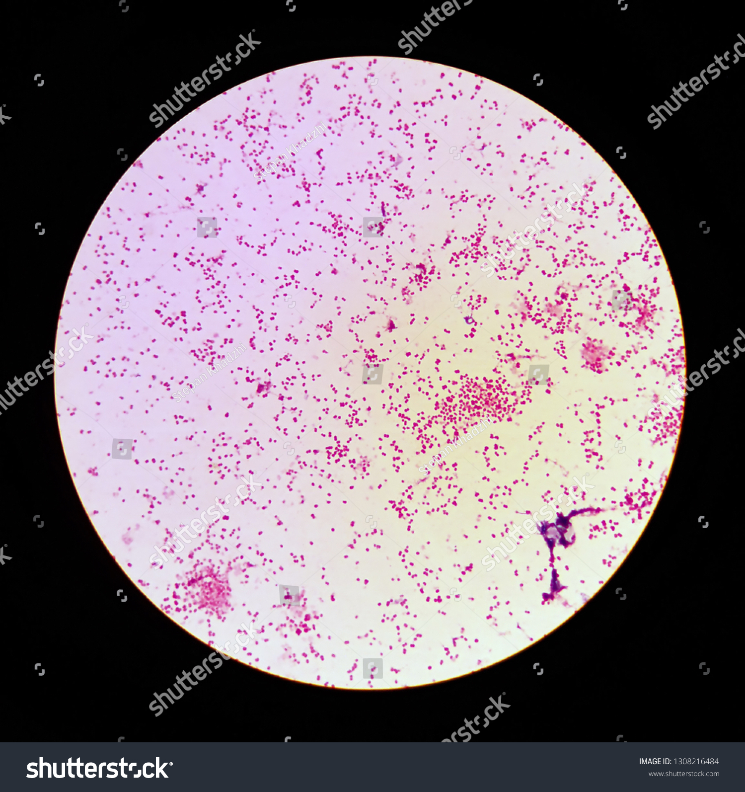 <p><strong>Lab differentiation:</strong></p><ul><li><p><strong>Gram stain: Gram-negative diplococci, </strong>often seen inside polymorphonuclear leukocytes from urethral or cervical specimens.</p></li><li><p><strong>Culture:</strong> Grows on <strong>Thayer-Martin agar</strong> (chocolate agar with antibiotics), forming small, gray-white, smooth colonies in 24ā48 hours.</p></li><li><p><strong>Tests:</strong> Oxidase-positive, carbohydrate utilization (ferments glucose only), NAATs for rapid molecular detection.</p></li></ul><p><span data-name="woman_health_worker" data-type="emoji">š©āā</span> <strong>Patient scenario:</strong><br>A 22-year-old woman presents with dysuria and purulent vaginal discharge. Urethral swab shows Gram-negative diplococci inside neutrophils. Culture on Thayer-Martin agar grows small gray-white colonies. Diagnosis: gonorrhea.</p><p><span data-name="clipboard" data-type="emoji">š</span> <strong>Details:</strong><br><strong>(A) Classification:</strong> Gram-negative diplococcus.<br><strong>(B) Disease:</strong> Causes <strong>gonorrhea</strong>, a sexually transmitted infection affecting urethra, cervix, rectum, throat, and eyes in newborns.<br><strong>(C) Identification/Diagnosis:</strong> Clinical symptoms, Gram stain, culture on selective media, or NAAT.<br><strong>(D) Treatment/Prevention:</strong> <strong>Ceftriaxone</strong> single dose; use condoms to prevent transmission. Screening and partner treatment critical.<br><strong>(E) Unique Epidemiology & Lab Safety:</strong> Humans are the only host; high antigenic variation enables immune evasion; increasing antibiotic resistance. BSL-2 precautions for lab work.</p>