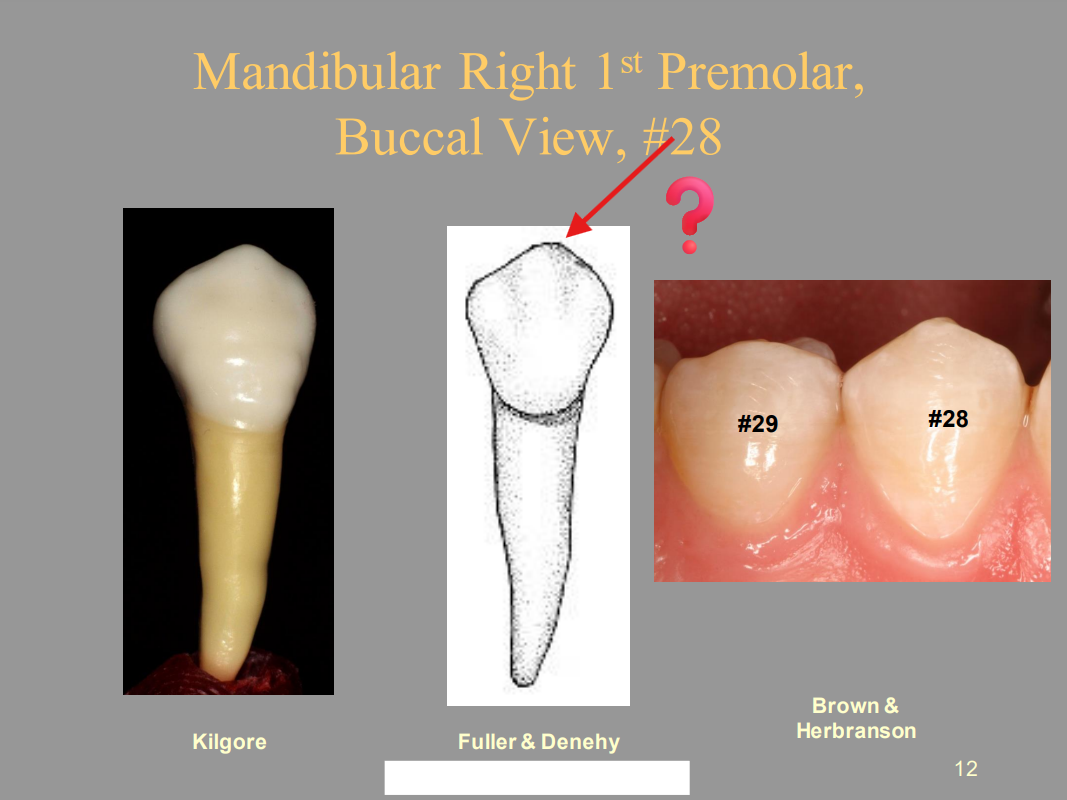 <p>From the picture shown of the Mandibular 1st Premolar, The red arrow is pointing at the Buccal Cusp. Where is the Buccal Cusp OFFSET to?</p><p>A. Mesial</p><p>B. Distal</p><p>C. Buccal</p><p>D. Lingual</p>