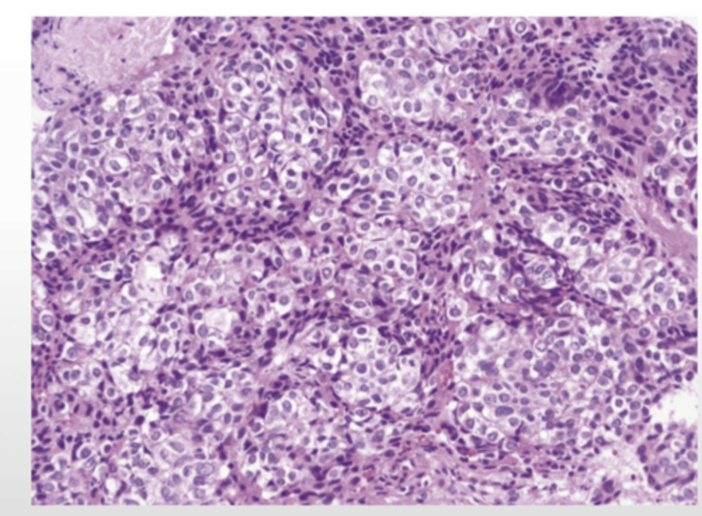 <p>rare malignancy of the liver that usually occurs in children under 3yrs old</p>