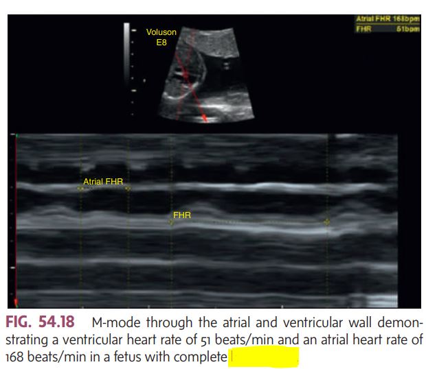 <ul><li><p><mark data-color="blue" style="background-color: blue; color: inherit;"> most common in women of childbearing age </mark></p></li><li><p>Systemic lupus erythematosus (SLE) is a chronic autoimmune disorder that can affect almost all organ systems in the body. I</p></li><li><p>3-5 times higher rate of preeclampsia</p></li><li><p>increased spontaneous abortions, stillbirths, and growth-restricted fetuses. </p></li><li><p>The fetal heart must be monitored to rule out congenital _________ (Fig. 54.18) and pericardial effusion.</p></li></ul><p></p>