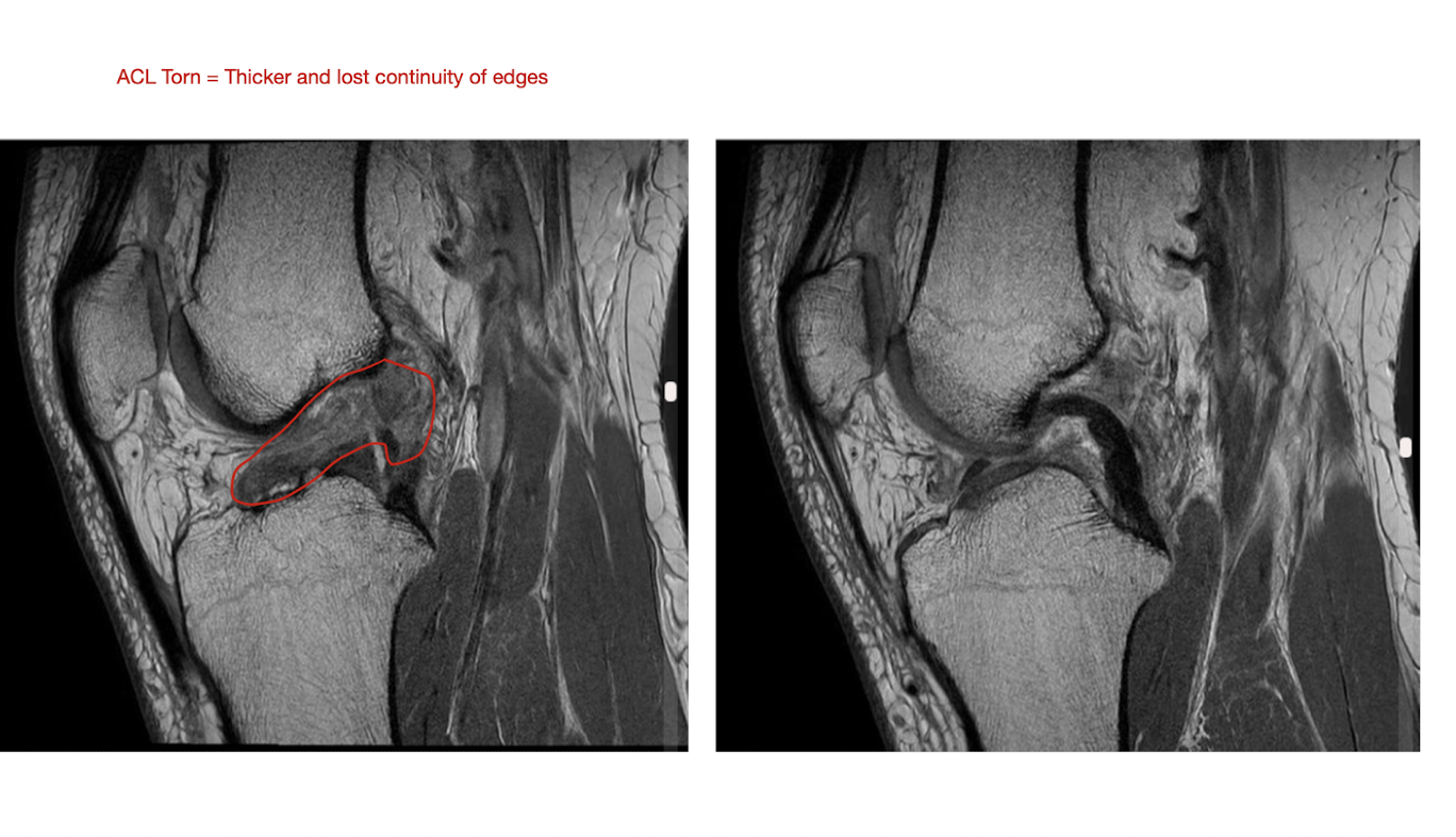 <p>ACL Pathology: MOI</p><ul><li><p>4 main MOI</p></li></ul><p></p><p></p>