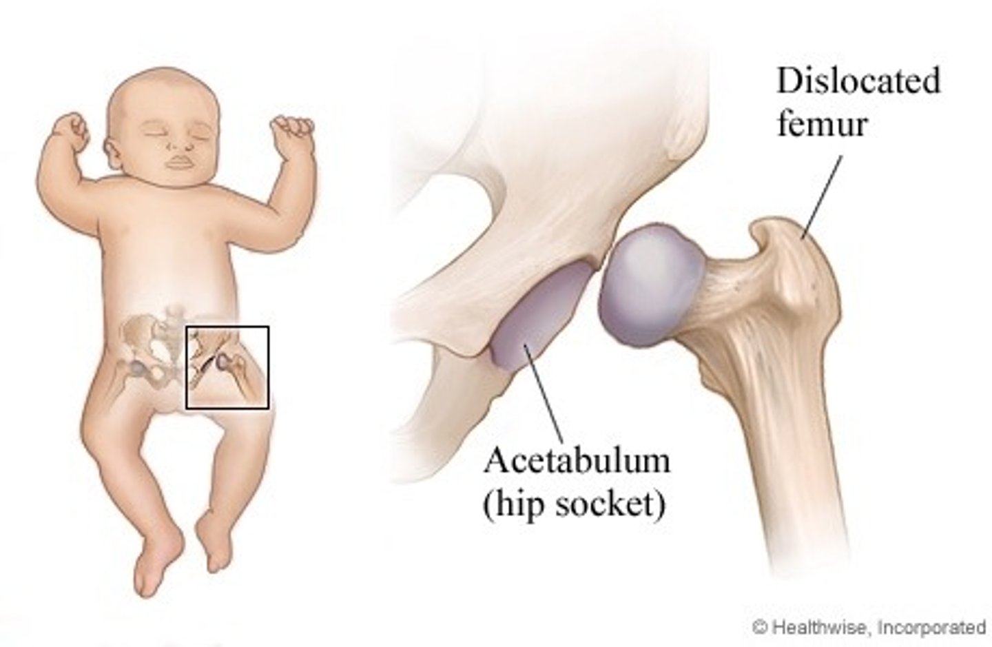 <p>spectrum of disorders usually seen in infancy that result in a femur/acetabulum joint that is dislocatable or partially dislocatable</p>