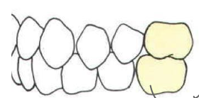 <p>type of occlusion</p>