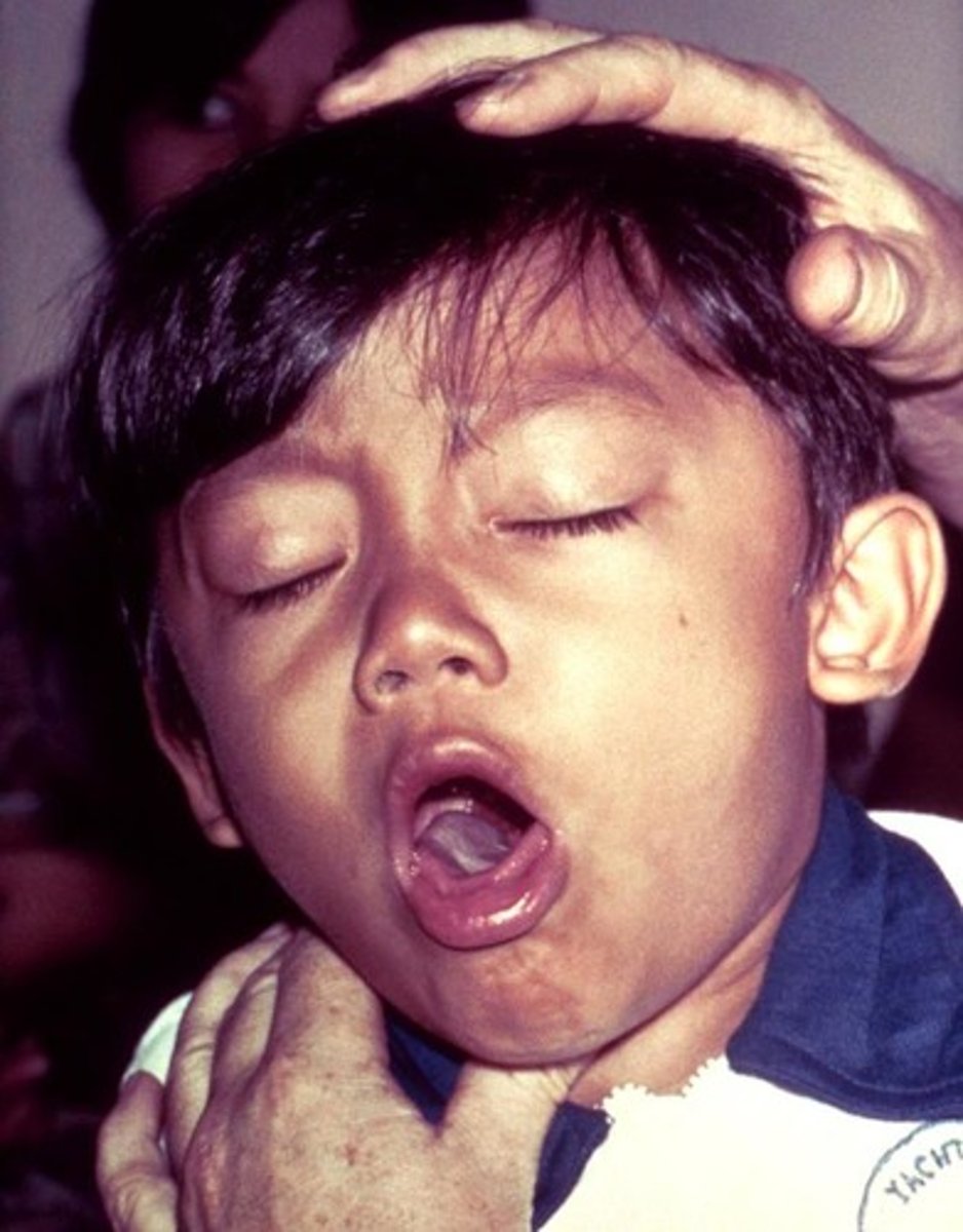 <p>whooping cough</p>