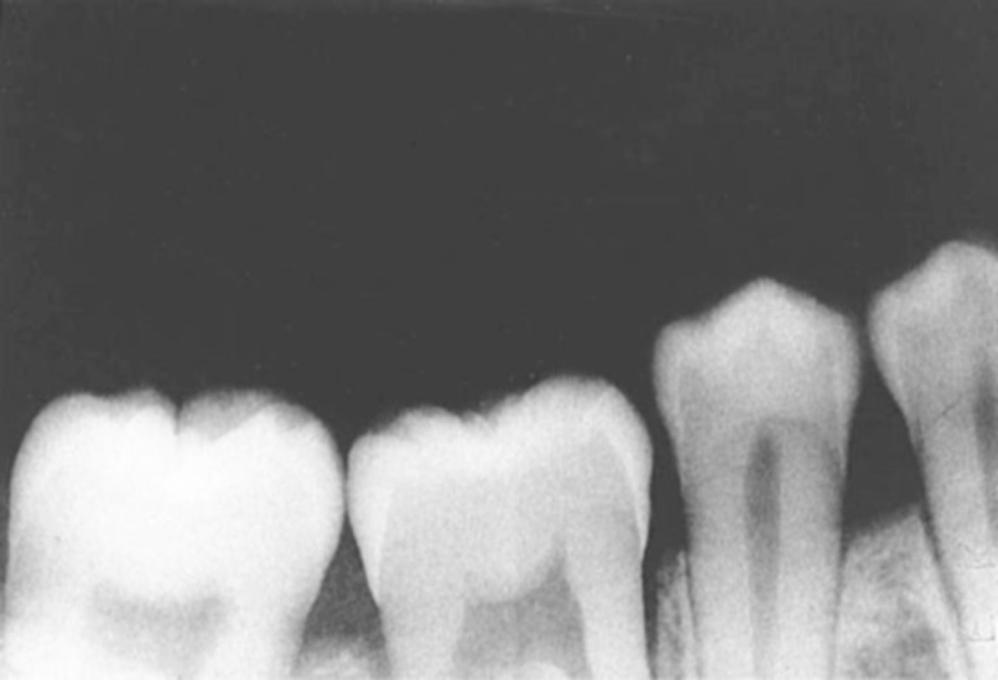<p>receptor not positioned to cover apical region of teeth</p><p>bite block not placed on the teeth being exposed</p>