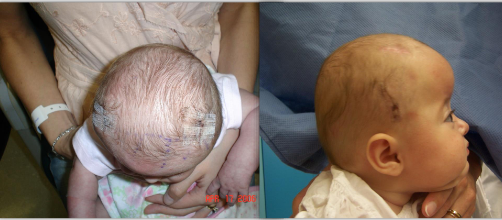 <ul><li><p>Ridged ossification of both coronal sutures </p></li><li><p>tall forehead </p></li><li><p>bi-parietal widening, brachycephalic</p></li></ul><p></p>