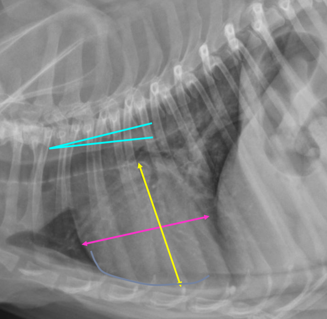 <p>-round heart</p><p>-2/3 or greater DV diameter</p><p>-3-3.5 IC spaces</p><p>-less tracheal deviation</p><p>-greater sternal contact</p>