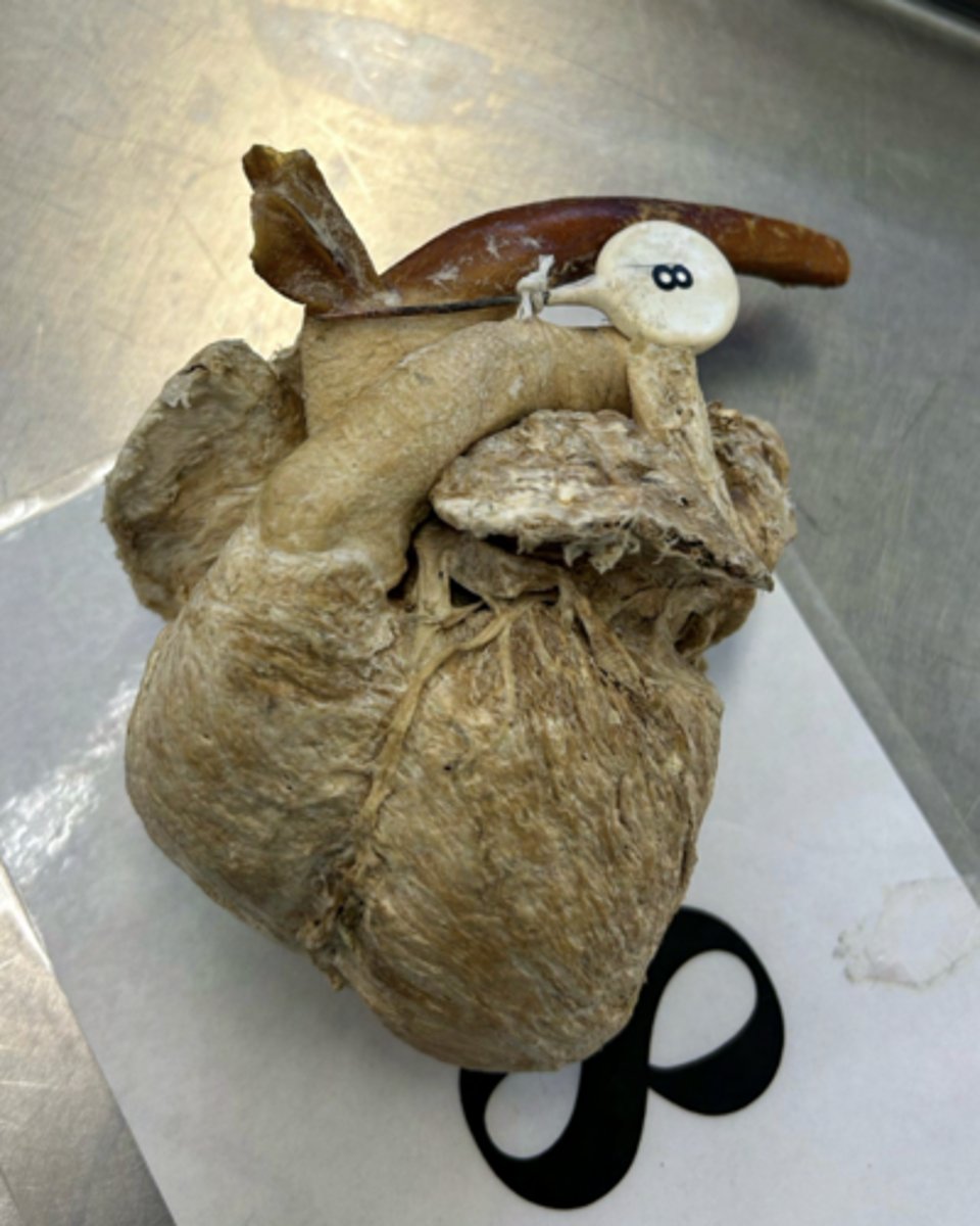<p>This structure shunts fetal blood from which vessel into which vessel?</p>