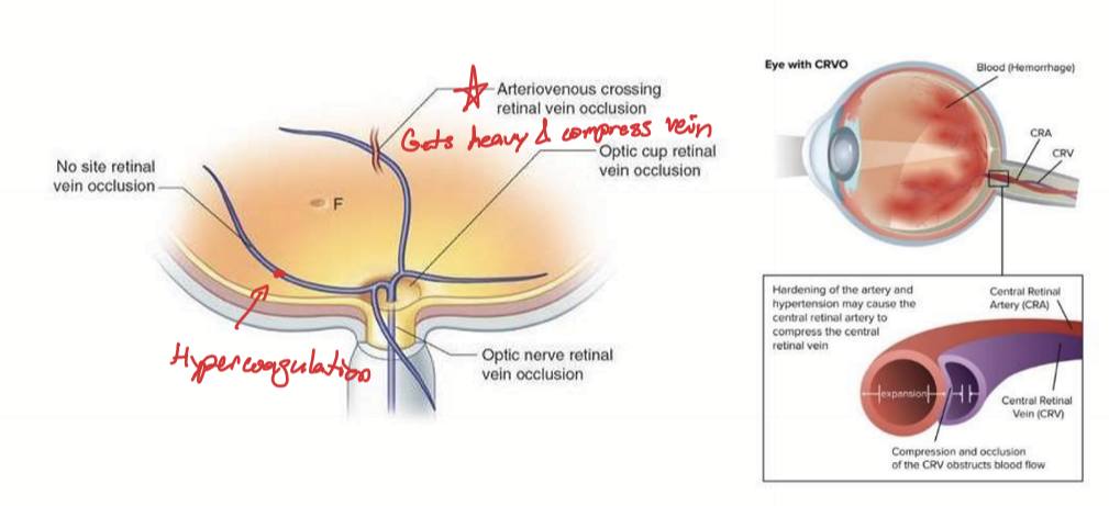 <p>90-95% caused by arteriosclerosis; In retina arteries cross over retinal veins at arteriovenous crossings, sharing adventitia. The arterial disease then occludes the vein.</p>