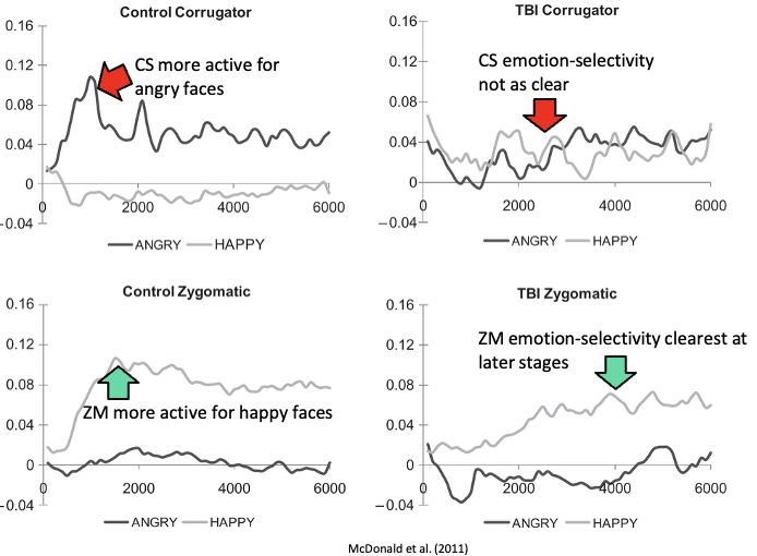 <ul><li><p><span><span>Clearer emotion-selective distinction from muscles in controls (particularly at earlier stages)</span></span></p></li><li><p><span><span>Clearest emotion-selective distinction from ZM in TBI participants</span></span></p></li></ul><p></p><p>C says: the frowning muscle more active when looking at angry faces (think there is an animation on the graph) but saw the flip pattern in ZM</p><ul><li><p><span><span>Angry faces should have elicited more CS activity but did not find this in TBI</span></span></p><ul><li><p><span><span>May be finding these because of static faces so need to look at dynamic</span></span></p></li></ul></li></ul><p></p>