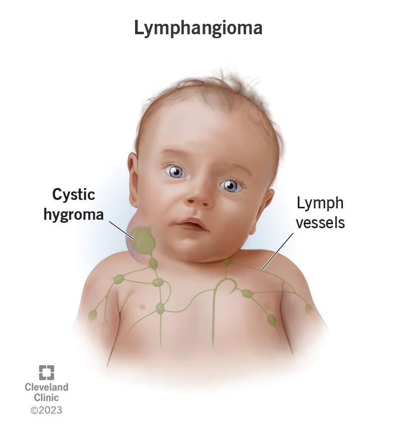 <p>Benign tumor caused by congenital malformation of the lymphatic system</p>