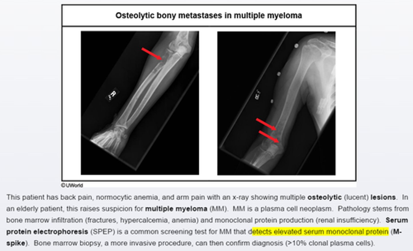 <p>-bone pain is common presenting syndrome in multiple myeloma</p><p>-elderly pts wtih evidence of osteolytic lesions on X ray should suspect MM</p><p>-screening test is serum/urine protein electrophoresis</p><p>-diagnosis can be confirmed with bone marrow biopsy</p>
