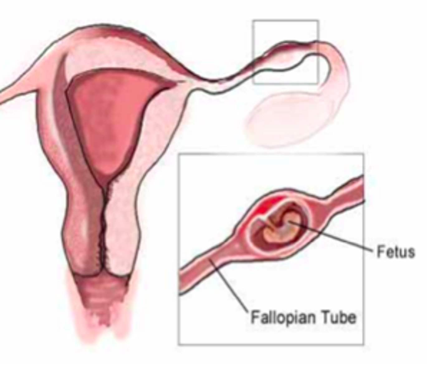 <p>pregnancy that is out of the uterus (usually occuring in fallopian tubes)</p>