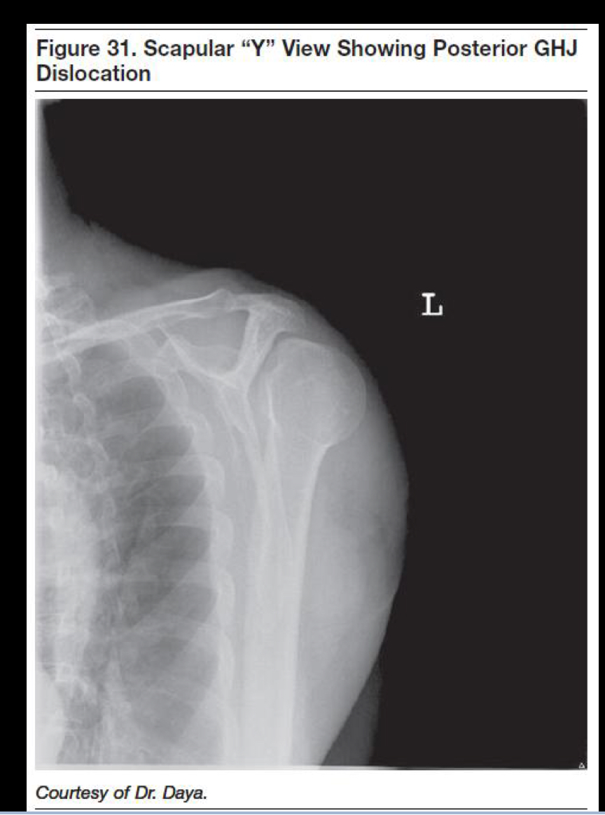 <p>What is the clinical diagnosis of this dislocation?</p>