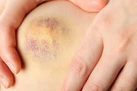 <p>Tipo de moretón, hematoma que se forma cuando los vasos sanguíneos debaj de la piel se rompen, provocando una fuga de sangre en los tejidos circundantes.</p><ul><li><p>No forma masa, no es palpable</p></li><li><p>cambia de color conforme se degrada la hemoglobina</p></li><li><p>Reproduce la forma del elemento que la originó. <strong>Se puede inferir la compatibilidad entre la lesión y el agente.</strong></p></li></ul><p></p>