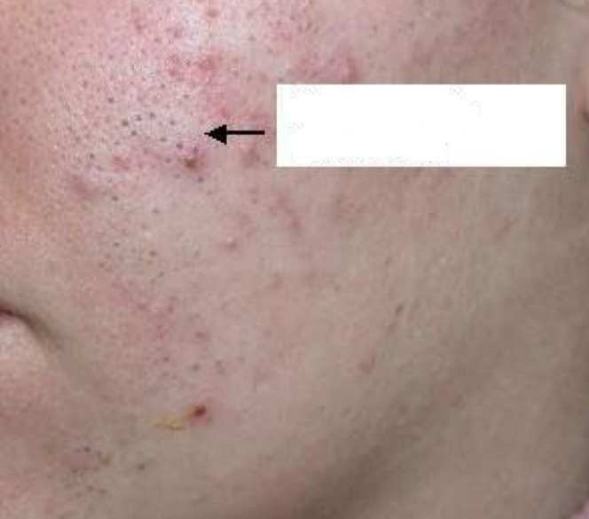 <p>what type of lesion and condition is depicted</p>