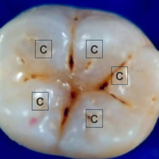 posterior tooth cusps