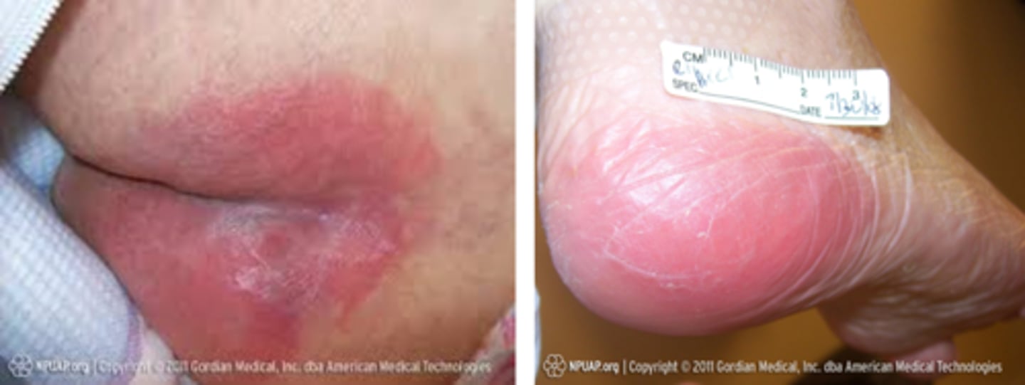 <p>- Nonblanchable erythema of INTACT skin</p><p>- Usually over bony prominence</p><p>- Changes in sensation, temp, or firmness may proceed</p>