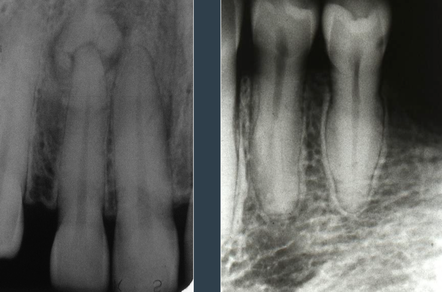 <p>Cemento-osseous dysplasia is not within the PDL space whereas in hypercementosis, the radiodensity is all within the PDL</p>