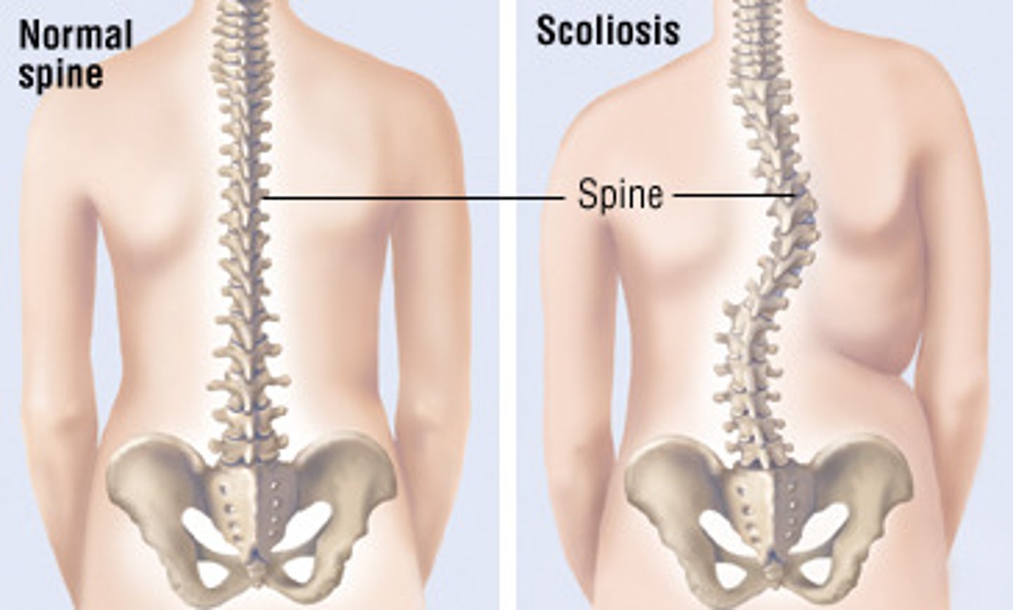 <p>a lateral curvature of the spine.</p>