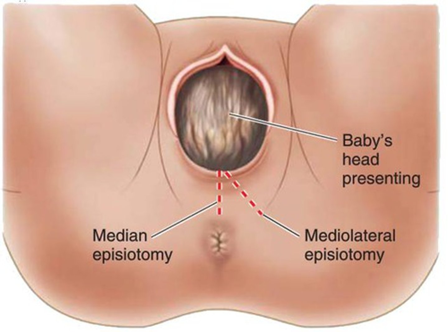 <p>incision of the perineum (also perineotomy)</p>