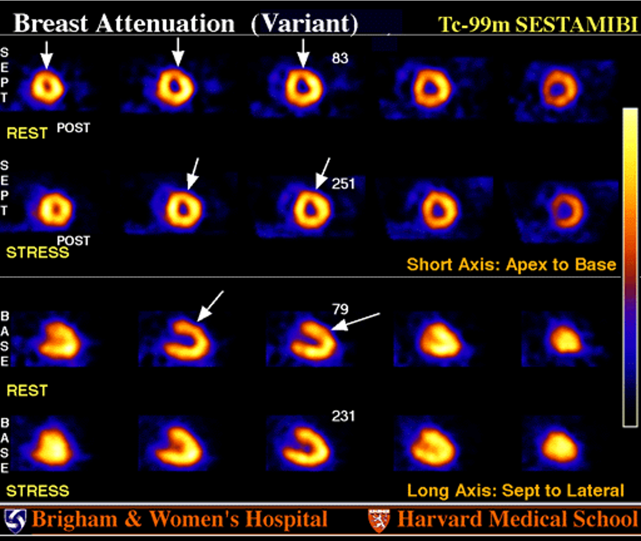 <p>An anterior wall defect present on both rest + stress images but with normal wall motion likely represents:</p>